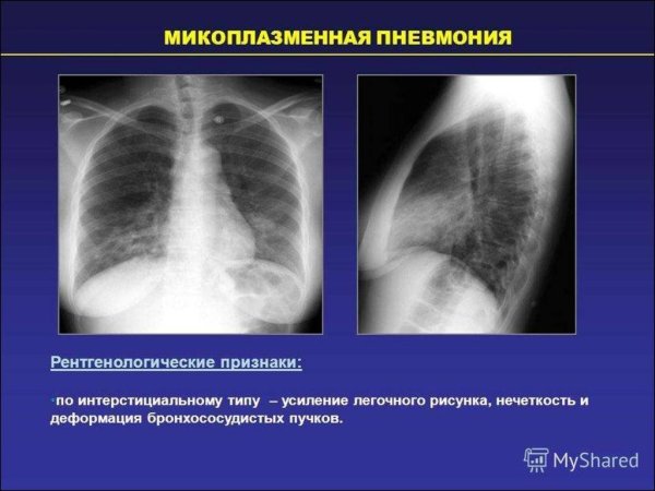 Усиление бронхиального рисунка рентген