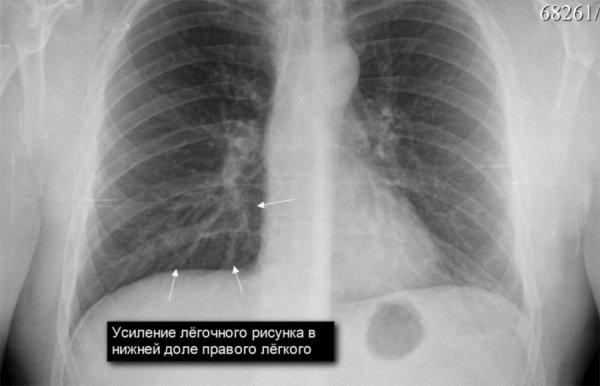 Изменение легочного рисунка