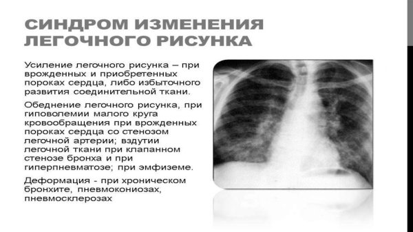 Усиленный легочный рисунок