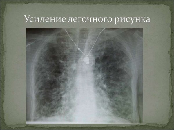 Диафрагмально плевральные спайки
