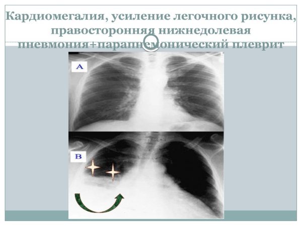 Изменение легочного рисунка