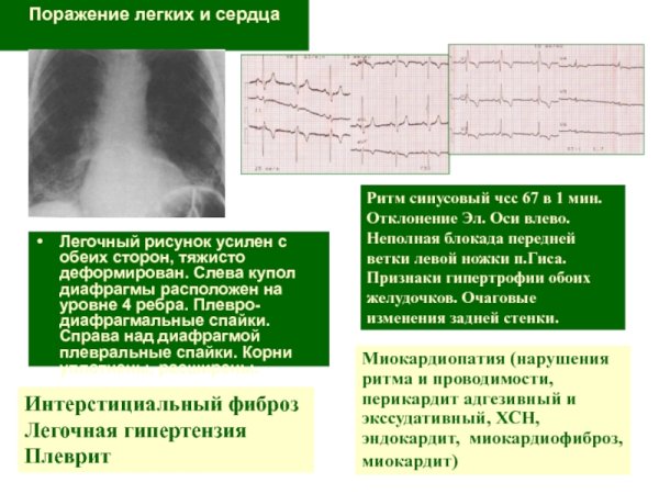 Усиление бронхиального рисунка рентген