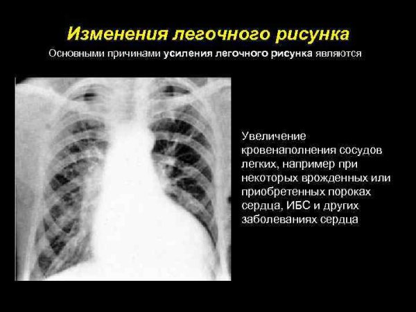 Ослабление легочного рисунка