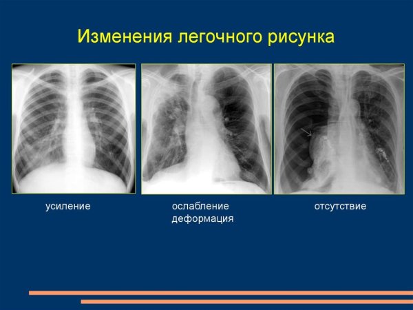 Описание рентгена при бронхите у детей