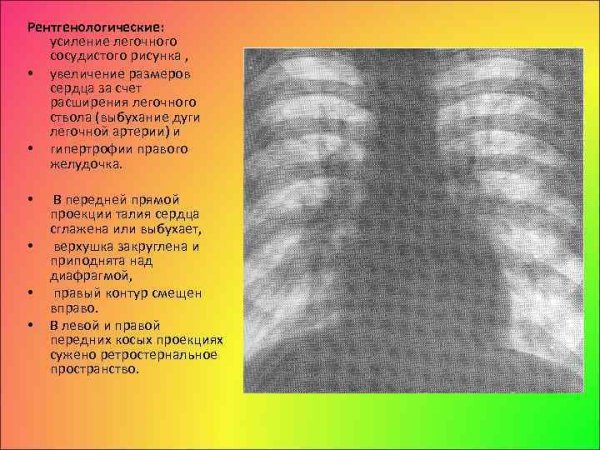 Усиление рисунка легких что это