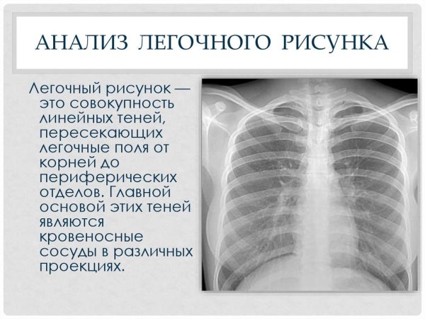 Усиление бронхососудистого рисунка