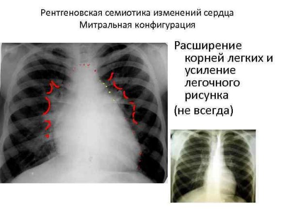 Изменение легочного рисунка