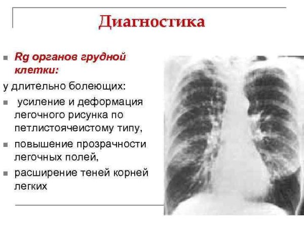 Легочный рисунок