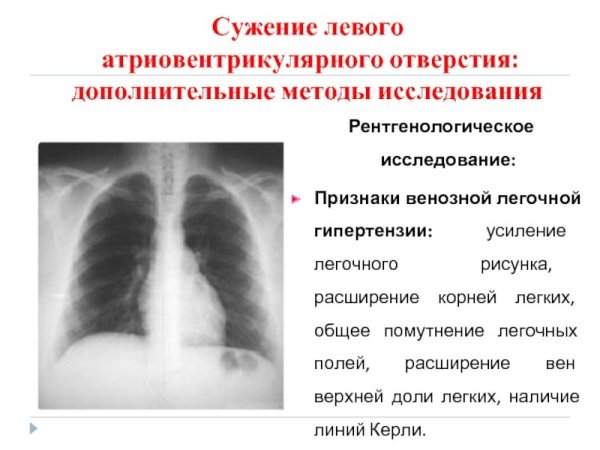 Синдром изменения легочного рисунка рентген