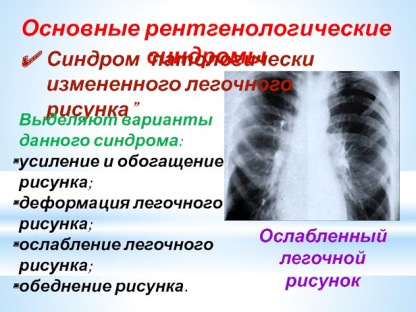 Деформация легочного рисунка