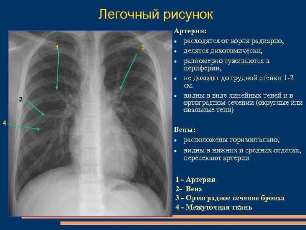 Усиление бронхиального рисунка рентген