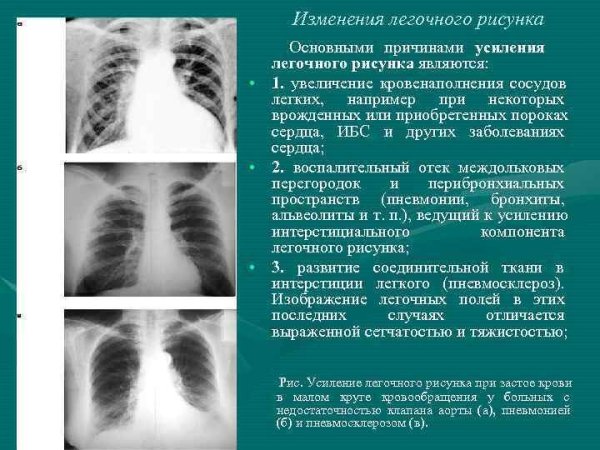 Усиление и деформация легочного рисунка на рентгене что это