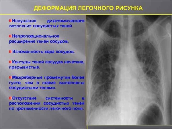 Усиление легочного рисунка на рентгене