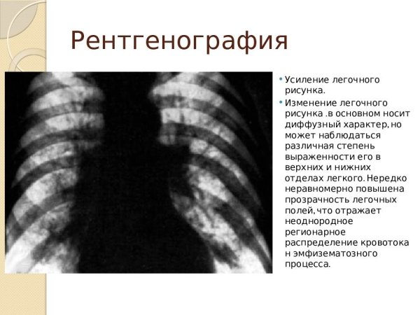 Усиление легочного рисунка
