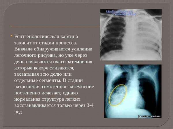 Деформация легочного рисунка на рентгене