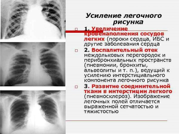 Рентгенологический корень легкого