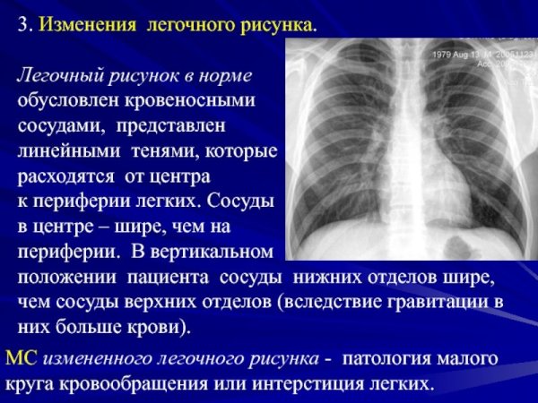 Бронхоэктатическая болезнь бронхография
