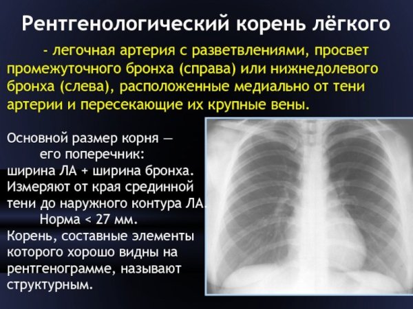Рентгенограммы органов грудной клетки пневмония