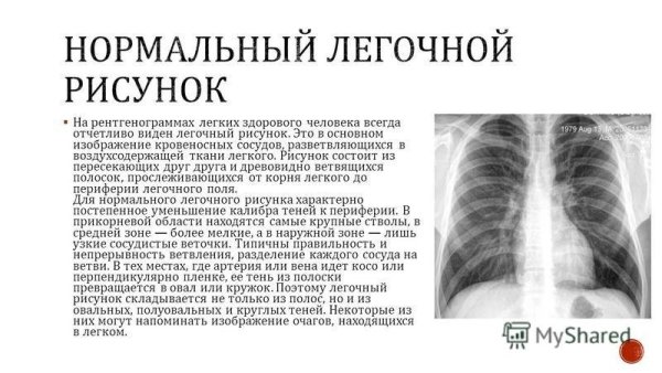 Инфильтративный туберкулез рентгенодиагностика