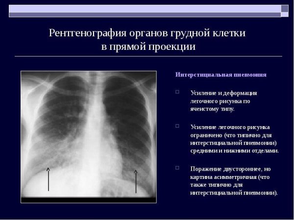 Инфильтративный туберкулез рентген