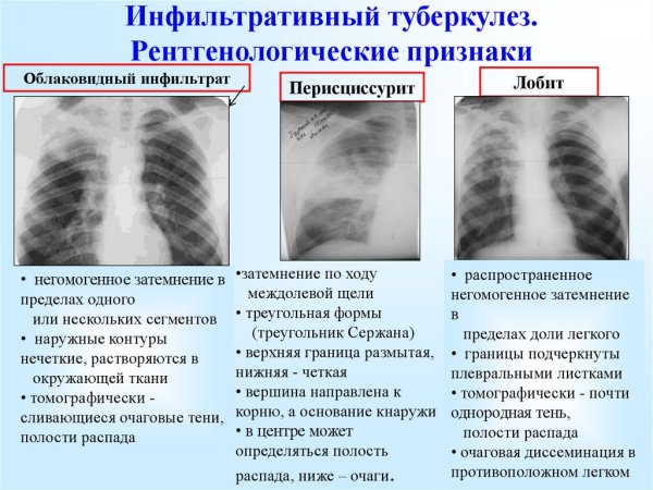 Усиление легочного рисунка