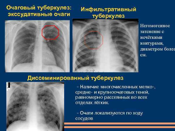 Легочный рисунок рентген