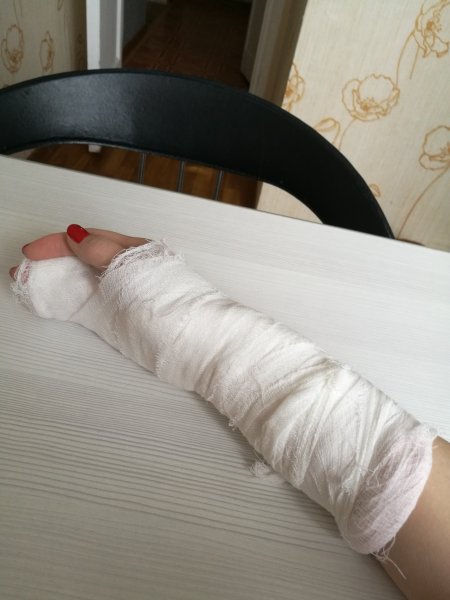 Сломанная рука в гипсе у девушки