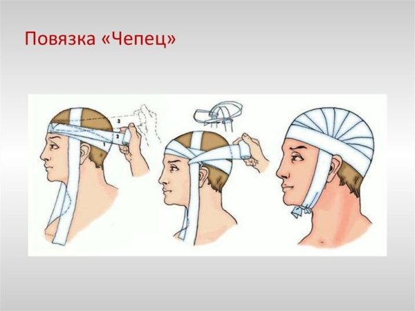 Десмургия повязка чепец