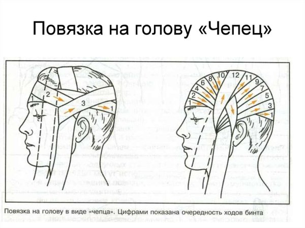 Методика наложения повязки чепец