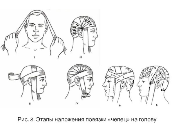 Десмургия повязка чепец
