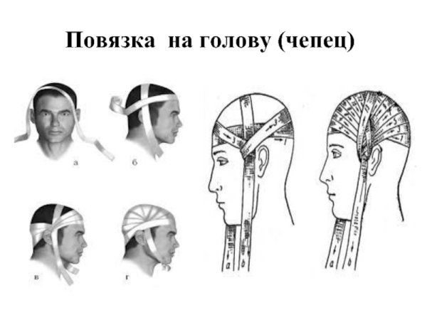Повязка чепец техника наложения