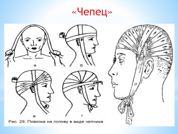 Бинтование головы чепец