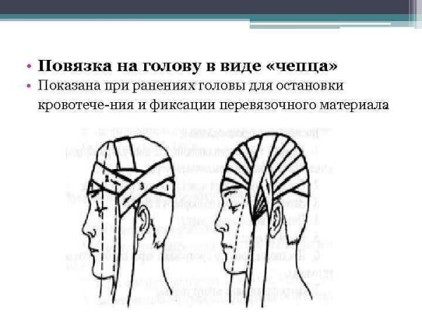 Неаполитанская повязка на ухо алгоритм
