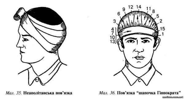 Наложение повязки при ранении волосистой части головы