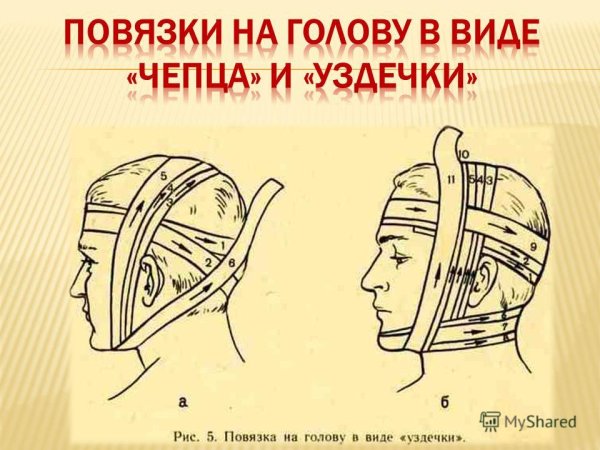 Перевязка головы бинтом чепец