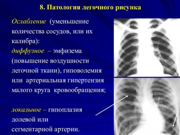 Ослабление легочного рисунка