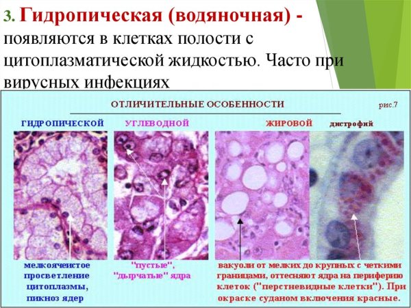 Паренхиматозная углеводная дистрофия почки