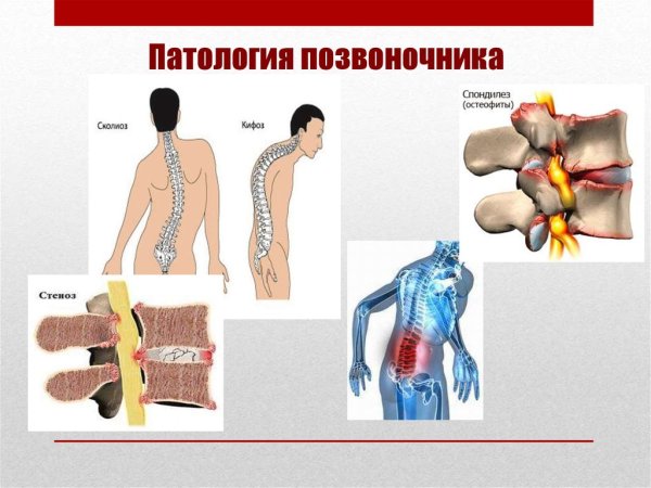 Нарушения позвоночника
