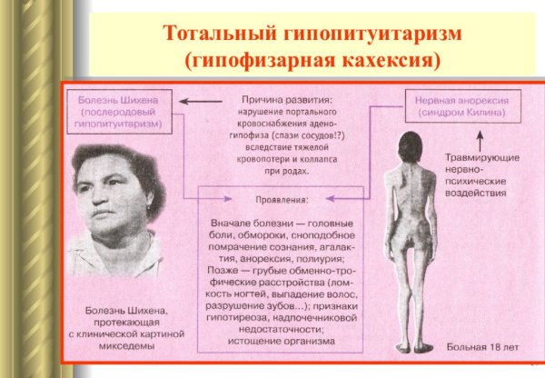Гипофизарная кахексия болезнь Симмондса