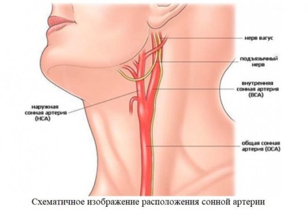 Массаж каротидного синуса