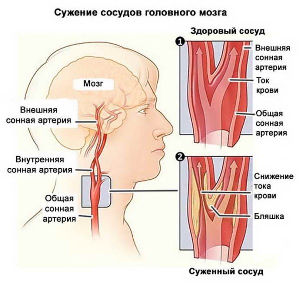 Окклюзия сонной артерии