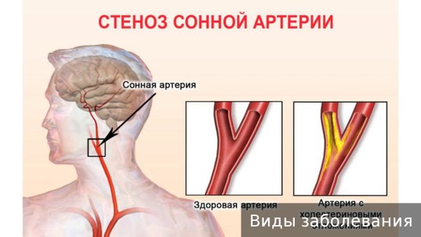 Сонный гломус анатомия