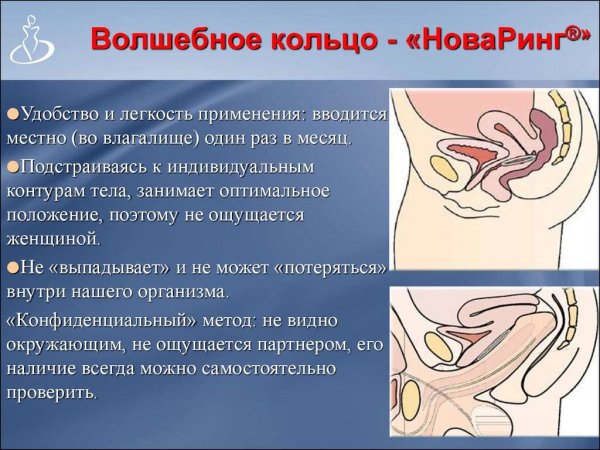 Влагалищное кольцо новаринг