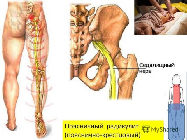 Дерматомы седалищного нерва
