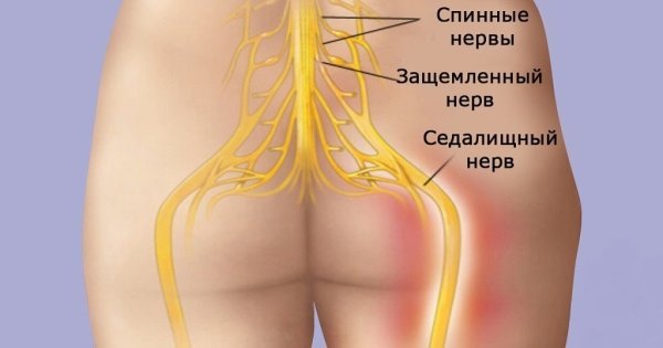 Седалищный нерв анатомия схема