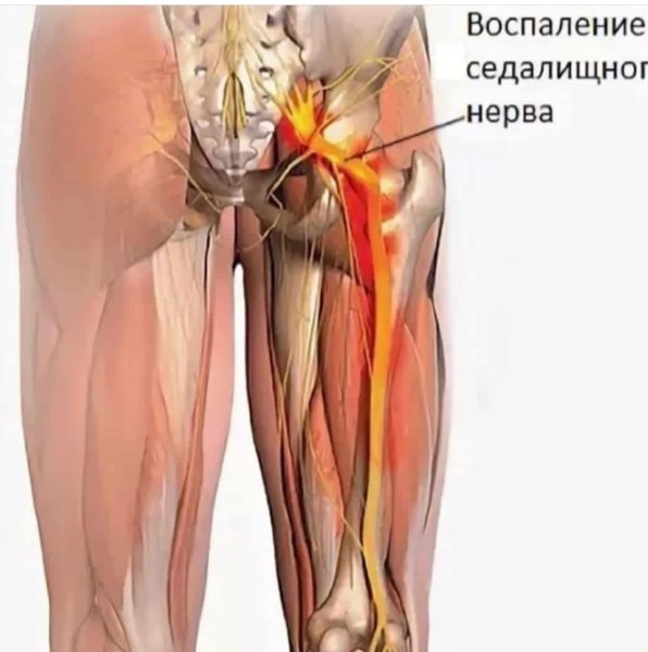 Седалищный нерв на ягодице
