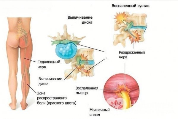 Седалищный нерв левая нога