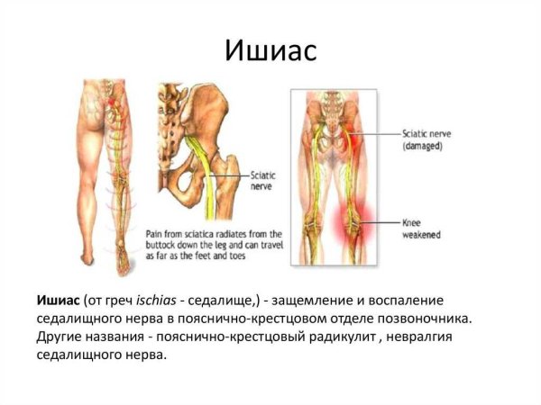 Защемление седалищного нерва рисунок
