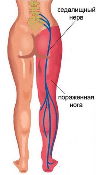 Седалищный нерв