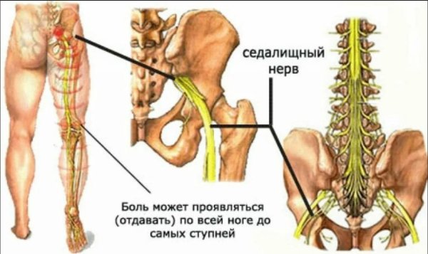Защемление седалищного нерва